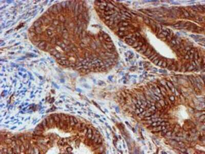 Immunohistochemistry: SCFD1 Antibody (OTI5G4) - Azide and BSA Free [NBP2-74004] - Staining of paraffin-embedded Adenocarcinoma of Human endometrium tissue using anti-SCFD1 mouse monoclonal antibody.