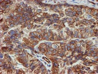 Immunohistochemistry: SCFD1 Antibody (OTI5G4) - Azide and BSA Free [NBP2-74004] - Staining of paraffin-embedded Adenocarcinoma of Human ovary tissue using anti-SCFD1 mouse monoclonal antibody.