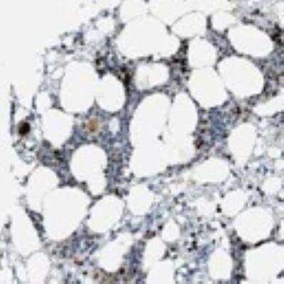 Immunohistochemistry: SCL/Tal1 Antibody [25610002] - A majority of the normal cells showed moderate cytoplasmic positivity with additional nuclear positivity in few cases. Strong cytoplasmic positivity was seen in Purkinje cells and strong nuclear staining in bone marrow poetic cells. Hepatocytes showed moderate nuclear staining. Squamous epithelia and lymphoid tissues in general were negative or weakly stained. Most of the malignant cells were weakly stained or negative. Few cases of ovarian, endometrial and liver cancers displayed moderate cytoplasmic positivity with additional nuclear immunoreactivity in some cases. Lymphomas were all negative.  Image and statement courtesy of the Human Protein Atlas (HPA).