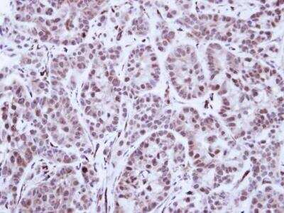 Immunohistochemistry-Paraffin: SCL/Tal1 Antibody [NBP1-33757] - A549 Xenograft , using TAL1 antibody at 1:100 dilution. Antigen Retrieval: Trilogy™ (EDTA based, pH 8.0) buffer, 15min.