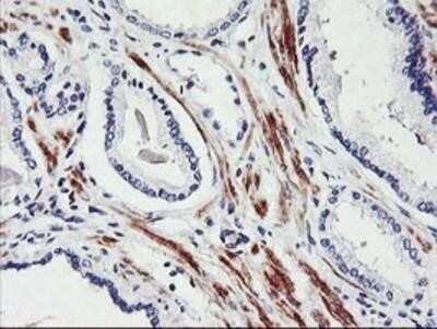 Immunohistochemistry: SCL/Tal1 Antibody (OTI5H1) - Azide and BSA Free [NBP2-74022] - Staining of paraffin-embedded Carcinoma of Human prostate tissue using anti-Tal1 mouse monoclonal antibody.