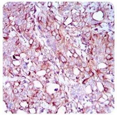 Immunohistochemistry-Paraffin: SCP3/SYCP3 Antibody (6F9C5) - Azide and BSA Free [NBP2-80942] - Analysis of paraffin-emebedded human cervical cancer tissues with DAB staining. Image from the standard format of this antibody.