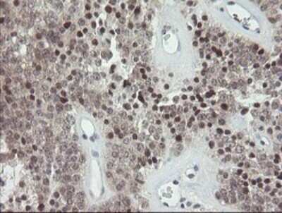 Immunohistochemistry: SCYL1BP1 Antibody (4F11) [NBP2-45912] - Analysis of Carcinoma of Human pancreas tissue.