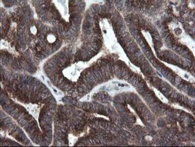 Immunohistochemistry: SCYL1BP1 Antibody (OTI4F11) - Azide and BSA Free [NBP2-74029] - Analysis of Adenocarcinoma of Human endometrium tissue.