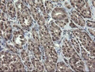 Immunohistochemistry: SCYL1BP1 Antibody (OTI4F11) - Azide and BSA Free [NBP2-74029] - Analysis of Carcinoma of Human thyroid tissue.