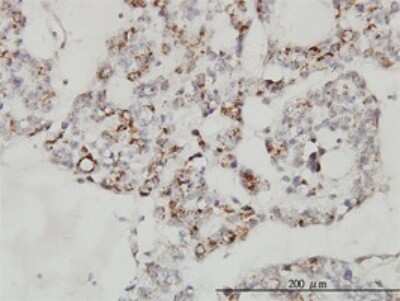 Immunohistochemistry-Paraffin: SDNSF/MCFD2 Antibody (3A5-G4) [H00090411-M01] - Analysis of monoclonal antibody to MCFD2 on formalin-fixed paraffin-embedded human ovary, clear cell carcinoma. Antibody concentration 3 ug/ml.