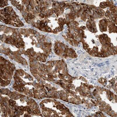 Immunohistochemistry-Paraffin: SDR16C5 Antibody [NBP1-87150] - Staining of human lung cancer, adenocarcinoma shows strong cytoplasmic positivity in tumor cells.