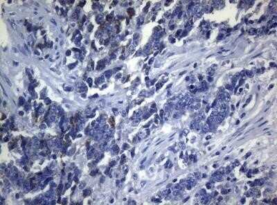 Immunohistochemistry: SEC14L1 Antibody (OTI3A6) - Azide and BSA Free [NBP2-74046] - Staining of paraffin-embedded Adenocarcinoma of Human endometrium tissue using anti-SEC14L1 mouse monoclonal antibody.