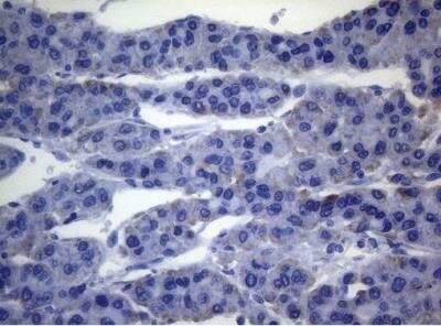 Immunohistochemistry-Paraffin: SEC14L1 Antibody (OTI3A6) [NBP2-45729] - Staining of paraffin-embedded Carcinoma of Human liver tissue using anti-SEC14L1 mouse monoclonal antibody.