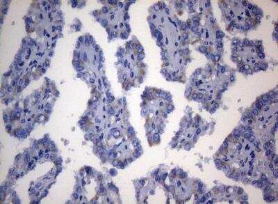 Immunohistochemistry-Paraffin: SEC14L1 Antibody (OTI3A6) [NBP2-45729] - Staining of paraffin-embedded Carcinoma of Human thyroid tissue using anti-SEC14L1 mouse monoclonal antibody.