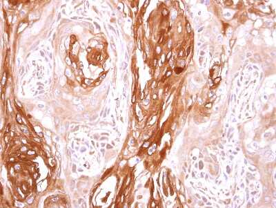 Immunohistochemistry-Paraffin: SEC23B Antibody [NBP2-20279] -  Ca922 oral cancer xenograft. SEC23B antibody dilution: 1:500.  Antigen Retrieval: Trilogy™ (EDTA based, pH 8.0) buffer, 15min.