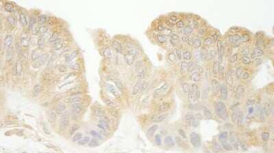 <b>Independent Antibodies Validation and Biological Strategies Validation.</b>Immunohistochemistry-Paraffin: SEC23IP Antibody [NB100-1563] - Sample: FFPE section of human ovarian carcinoma. Antibody: Affinity purified rabbit anti-expndtw-6 Sec23IP(MSTP053) used at a dilution of 1:200 (1ug/ml). Detection: DAB