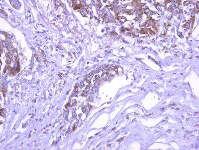 Immunohistochemistry-Paraffin: SEC3 Antibody [NBP2-20281] - Paraffin-embedded Colon cancer xenograft. SEC3 antibody dilution: 1:500.