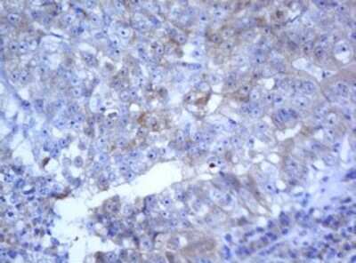 Immunohistochemistry: SELENBP1 Antibody (3H1) [NBP2-45979] - Analysis of Adenocarcinoma of Human colon tissue. (Heat-induced epitope retrieval by 10mM citric buffer, pH6.0, 120C for 3min)