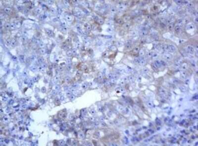 Immunohistochemistry: SELENBP1 Antibody (OTI3H1) - Azide and BSA Free [NBP2-74053] - Analysis of Adenocarcinoma of Human colon tissue. (Heat-induced epitope retrieval by 10mM citric buffer, pH6.0, 120C for 3min)