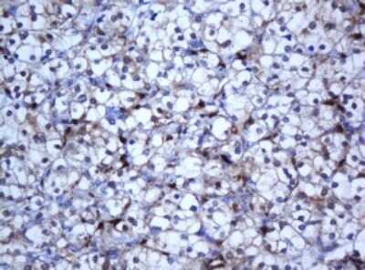 Immunohistochemistry: SELENBP1 Antibody (OTI3H1) - Azide and BSA Free [NBP2-74053] - Analysis of Carcinoma of Human kidney tissue. (Heat-induced epitope retrieval by 10mM citric buffer, pH6.0, 120C for 3min)