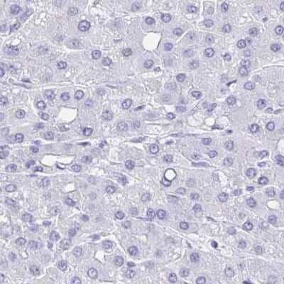 Immunohistochemistry: SELV Antibody [NBP2-32446] - Staining of liver cancer.