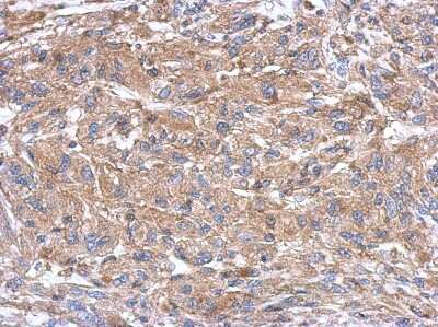Immunohistochemistry-Paraffin: Semaphorin 4B Antibody [NBP2-19299] - U373 xenograft, using SEMA4B antibody at 1:500 dilution. Antigen Retrieval: Trilogy™ (EDTA based, pH 8.0) buffer, 15min. 