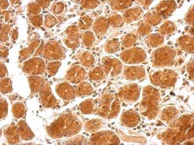 Immunohistochemistry-Paraffin: Semaphorin 4B Antibody [NBP2-19299] - Colon carcinoma.  SEMA4B antibody dilution: 1:500. Antigen Retrieval: Trilogy™ (EDTA based, pH 8.0) buffer, 15min. 