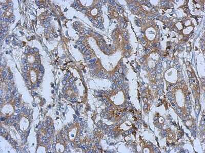 Immunohistochemistry-Paraffin: Semaphorin 5A Antibody [NBP2-20291] -  Gastric cancer, using Semaphorin 5A antibody at 1:500 dilution. Antigen Retrieval: Trilogy™ (EDTA based, pH 8.0) buffer, 15min