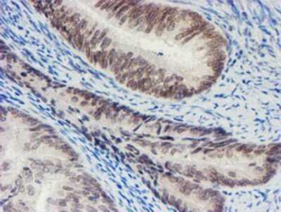 Immunohistochemistry: SENP2 Antibody (OTI3D3) - Azide and BSA Free [NBP2-74062] - Staining of paraffin-embedded Adenocarcinoma of Human endometrium tissue using anti-SENP2 mouse monoclonal antibody.