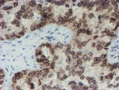 Immunohistochemistry: SENP2 Antibody (OTI3D3) - Azide and BSA Free [NBP2-74062] - Staining of paraffin-embedded Adenocarcinoma of Human ovary tissue using anti-SENP2 mouse monoclonal antibody.