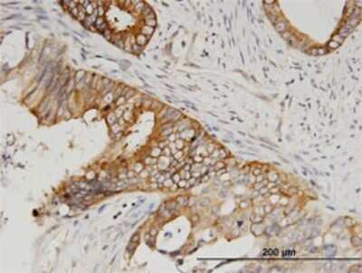 Immunohistochemistry-Paraffin: SERBP1 Antibody (1G5-2D7) [H00026135-M02] - Analysis of monoclonal antibody to SERBP1 on formalin-fixed paraffin-embedded human pancreatic cancer. Antibody concentration 3 ug/ml.