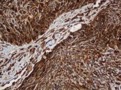 Immunohistochemistry: SERBP1 Antibody (5G2) [NBP2-45763] - Analysis of Carcinoma of Human lung tissue.(Heat-induced epitope retrieval by 10mM citric buffer, pH6.0, 120C for 3min)