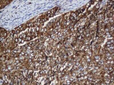 Immunohistochemistry: SERBP1 Antibody (5G2) [NBP2-45763] - Analysis of Adenocarcinoma of Human endometrium tissue. (Heat-induced epitope retrieval by 10mM citric buffer, pH6.0, 120C for 3min)