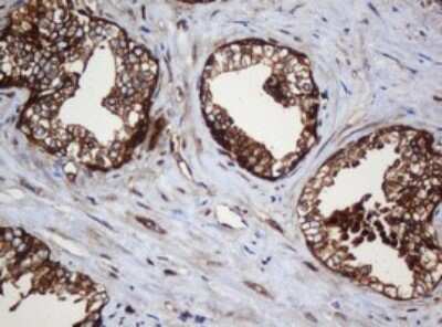 Immunohistochemistry: SERBP1 Antibody (5G2) [NBP2-45763] - Analysis of Carcinoma of Human prostate tissue. (Heat-induced epitope retrieval by 10mM citric buffer, pH6.0, 120C for 3min)