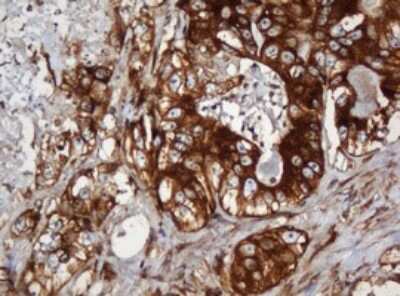 Immunohistochemistry: SERBP1 Antibody (5G2) [NBP2-45763] - Analysis of Adenocarcinoma of Human colon tissue. (Heat-induced epitope retrieval by 10mM citric buffer, pH6.0, 120C for 3min)