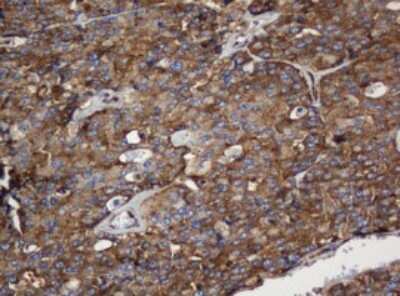 Immunohistochemistry: SERBP1 Antibody (5G2) [NBP2-45763] - Analysis of Carcinoma of Human thyroid tissue. (Heat-induced epitope retrieval by 10mM citric buffer, pH6.0, 120C for 3min)