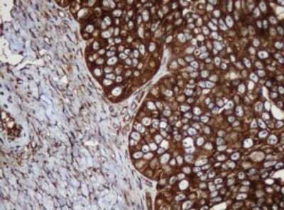 Immunohistochemistry: SERBP1 Antibody (5G2) [NBP2-45763] - Analysis of Adenocarcinoma of Human ovary tissue. (Heat-induced epitope retrieval by 10mM citric buffer, pH6.0, 120C for 3min)