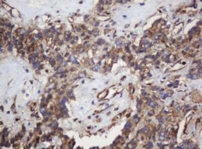 Immunohistochemistry: SERBP1 Antibody (5G2) [NBP2-45763] - Analysis of Carcinoma of Human pancreas tissue. (Heat-induced epitope retrieval by 10mM citric buffer, pH6.0, 120C for 3min)