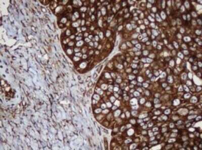Immunohistochemistry: SERBP1 Antibody (OTI5G2) - Azide and BSA Free [NBP2-74073] - Analysis of Adenocarcinoma of Human ovary tissue. (Heat-induced epitope retrieval by 10mM citric buffer, pH6.0, 120C for 3min)