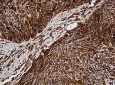Immunohistochemistry: SERBP1 Antibody (OTI5G2) - Azide and BSA Free [NBP2-74073] - Analysis of Carcinoma of Human lung tissue.(Heat-induced epitope retrieval by 10mM citric buffer, pH6.0, 120C for 3min)