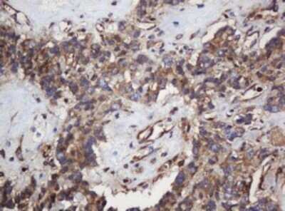 Immunohistochemistry: SERBP1 Antibody (OTI5G2) - Azide and BSA Free [NBP2-74073] - Analysis of Carcinoma of Human pancreas tissue. (Heat-induced epitope retrieval by 10mM citric buffer, pH6.0, 120C for 3min)