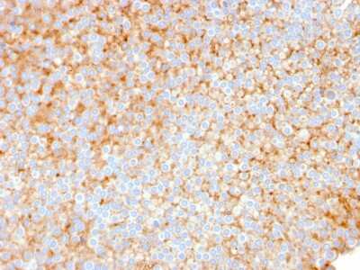 Immunohistochemistry-Paraffin: SERBP1 Antibody (SERBP1/3491) [NBP3-07610] - Formalin-fixed, paraffin-embedded human Urothelial Carcinoma stained with SERBP1 Mouse Monoclonal Antibody (SERBP1/3491).