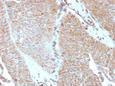 Immunohistochemistry-Paraffin: SERBP1 Antibody (SERBP1/3493) - Azide and BSA Free [NBP2-79939] - Formalin-fixed, paraffin-embedded human Urothelial Carcinoma stained with SERBP1 Mouse Monoclonal Antibody (SERBP1/3493).