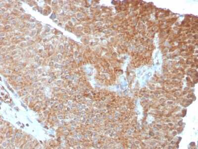 Immunohistochemistry-Paraffin: SERBP1 Antibody (SERBP1/3493) [NBP2-79805] - Formalin-fixed, paraffin-embedded human Urothelial Carcinoma stained with SERBP1 Antibody (SERBP1/3493).