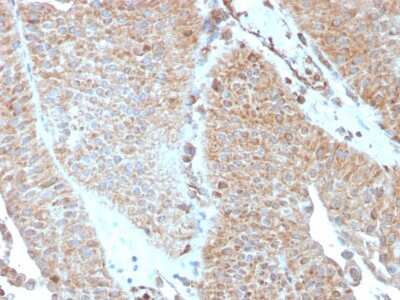 Immunohistochemistry-Paraffin: SERBP1 Antibody (SERBP1/3493) [NBP2-79805] - Formalin-fixed, paraffin-embedded human Urothelial Carcinoma stained with SERBP1 Antibody (SERBP1/3493).