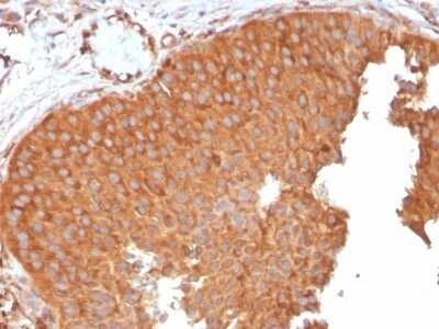 Immunohistochemistry-Paraffin: SERBP1 Antibody (SERBP1/3496) - Azide and BSA Free [NBP2-79844] - Formalin-fixed, paraffin-embedded human Urothelial Carcinoma stained with SERBP1 Antibody (SERBP1/3496).