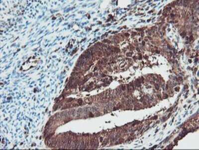 Immunohistochemistry: SERPINB1 Antibody (OTI3B4) - Azide and BSA Free [NBP2-74123] - Staining of paraffin-embedded Adenocarcinoma of Human endometrium tissue using anti-SERPINB1 mouse monoclonal antibody.