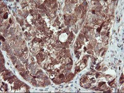 Immunohistochemistry: SERPINB1 Antibody (OTI3B4) - Azide and BSA Free [NBP2-74123] - Staining of paraffin-embedded Adenocarcinoma of Human ovary tissue using anti-SERPINB1 mouse monoclonal antibody.