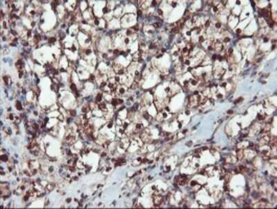 Immunohistochemistry: SERPINB1 Antibody (OTI3B4) - Azide and BSA Free [NBP2-74123] - Staining of paraffin-embedded Carcinoma of Human kidney tissue using anti-SERPINB1 mouse monoclonal antibody.