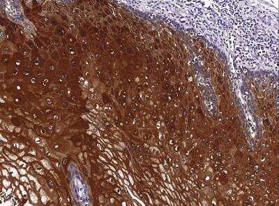 Immunohistochemistry-Paraffin: SERPINB4 Antibody (001) [NBP2-90154] - Immunochemical staining of human SERPINB4 in human esophageal carcinoma with rabbit monoclonal antibody (1:200, formalin-fixed paraffin embedded sections).
