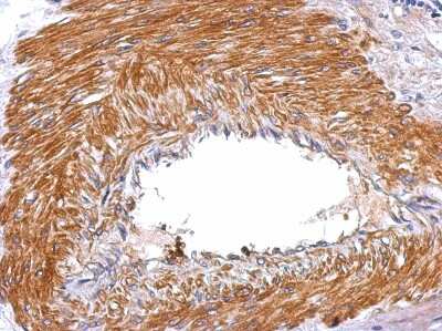 Immunohistochemistry-Paraffin: Serpin E2/PN1 Antibody [NBP2-20315] -  Human gastric cancer, using SERPINE2 antibody at 1:500 dilution. Antigen Retrieval: Trilogy™ (EDTA based, pH 8.0) buffer, 15min. 