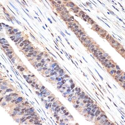 Immunohistochemistry-Paraffin: SESN1 Antibody (7I5Y4) [NBP3-15916] - Immunohistochemistry of paraffin-embedded human colon carcinoma using SESN1 Rabbit mAb (NBP3-15916) at dilution of 1:100 (40x lens).Perform microwave antigen retrieval with 10 mM Tris/EDTA buffer pH 9.0 before commencing with IHC staining protocol.