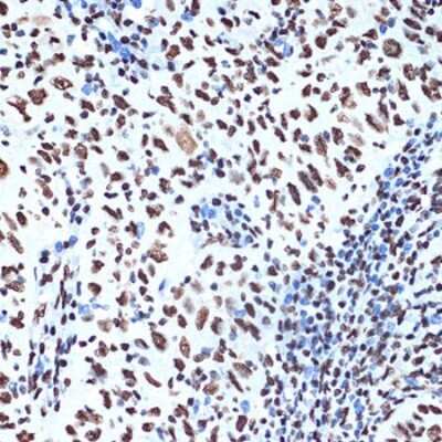 Immunohistochemistry-Paraffin: SET Antibody (8E8M9) [NBP3-16775] - Immunohistochemistry of paraffin-embedded human esophageal cancer using SET Rabbit mAb (NBP3-16775) at dilution of 1:100 (40x lens).Perform microwave antigen retrieval with 10 mM Tris/EDTA buffer pH 9.0 before commencing with IHC staining protocol.