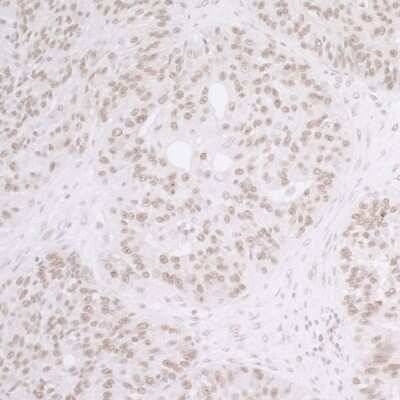 Immunohistochemistry: SET Antibody [NBP1-26646] - Sample: FFPE section of human ovarian carcinoma. Antibody: Affinity purified rabbit anti- SET used at a dilution of 1:1,000 (0.2ug/ml). Detection: DAB